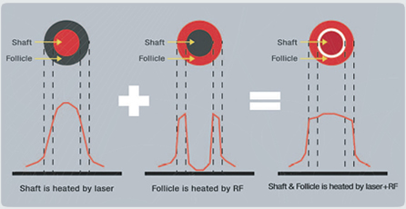 EPILIA RF